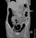 CT colon 22